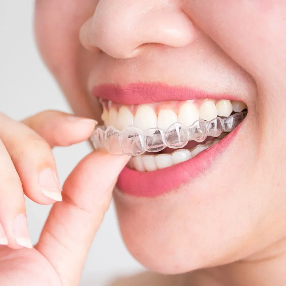 Teeth Whitening Mouth Guard - 1-4Pc Anti Snoring Bruxism Sleeping Mouth