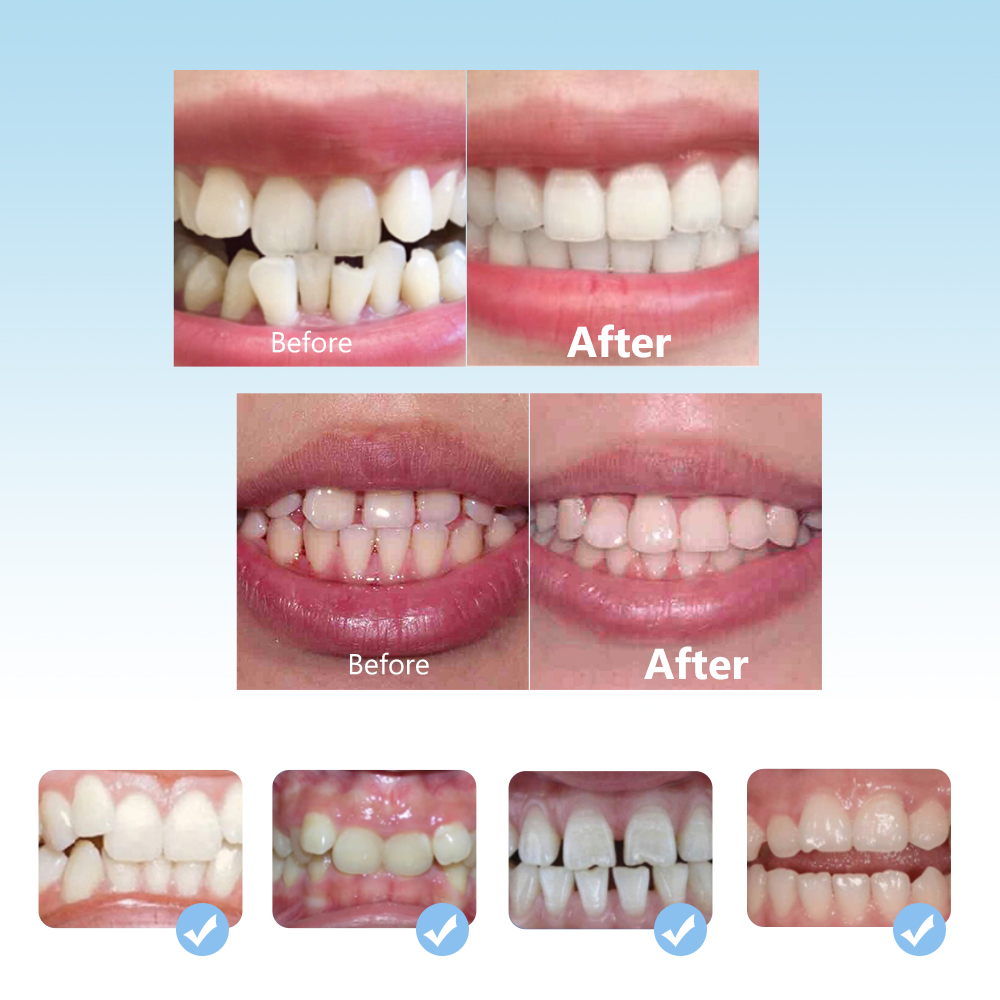 Dental Orthodontic Braces Set  - Teeth Whitening Mouth Guard review and price