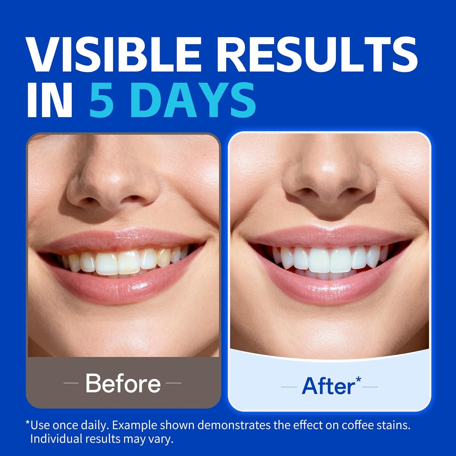 1/7 pairs Teeth Whitening Stri - Teeth Whitening Strips Permanent review and price