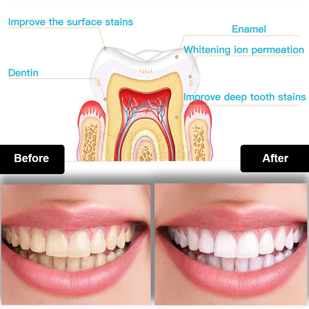 Dental Teeth Whitening Kit Min - Teeth Whitening Paste review and price